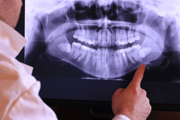 Best Emergency Wisdom Teeth Removal in Cedar Creek, TX